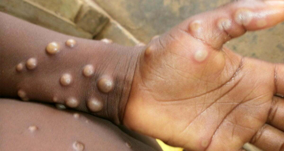 Is Monkeypox a Gay Man’s Disease?