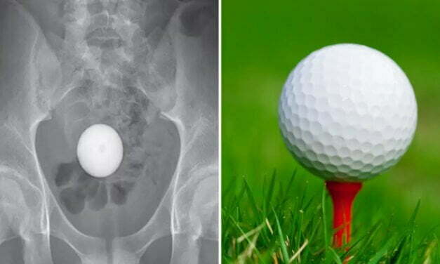 Teen lands bizarre hole in one — in his butt: How docs got it out