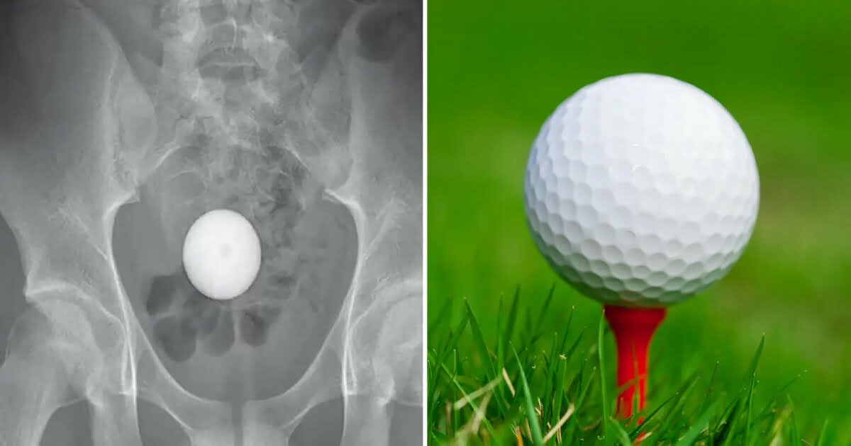 Teen lands bizarre hole in one — in his butt: How docs got it out