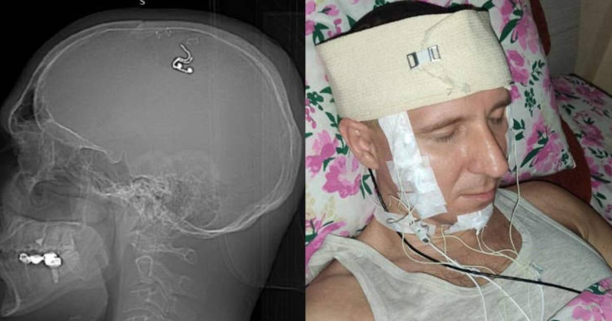 Scientist Claims to Have Performed Brain Surgery on Himself in His Living Room