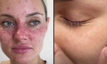 People are getting freckles tattooed onto their face in the latest fashion trend