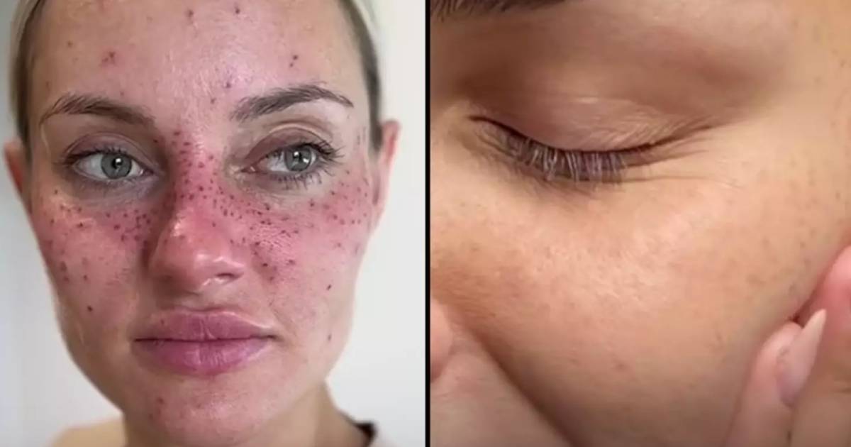 People are getting freckles tattooed onto their face in the latest fashion trend