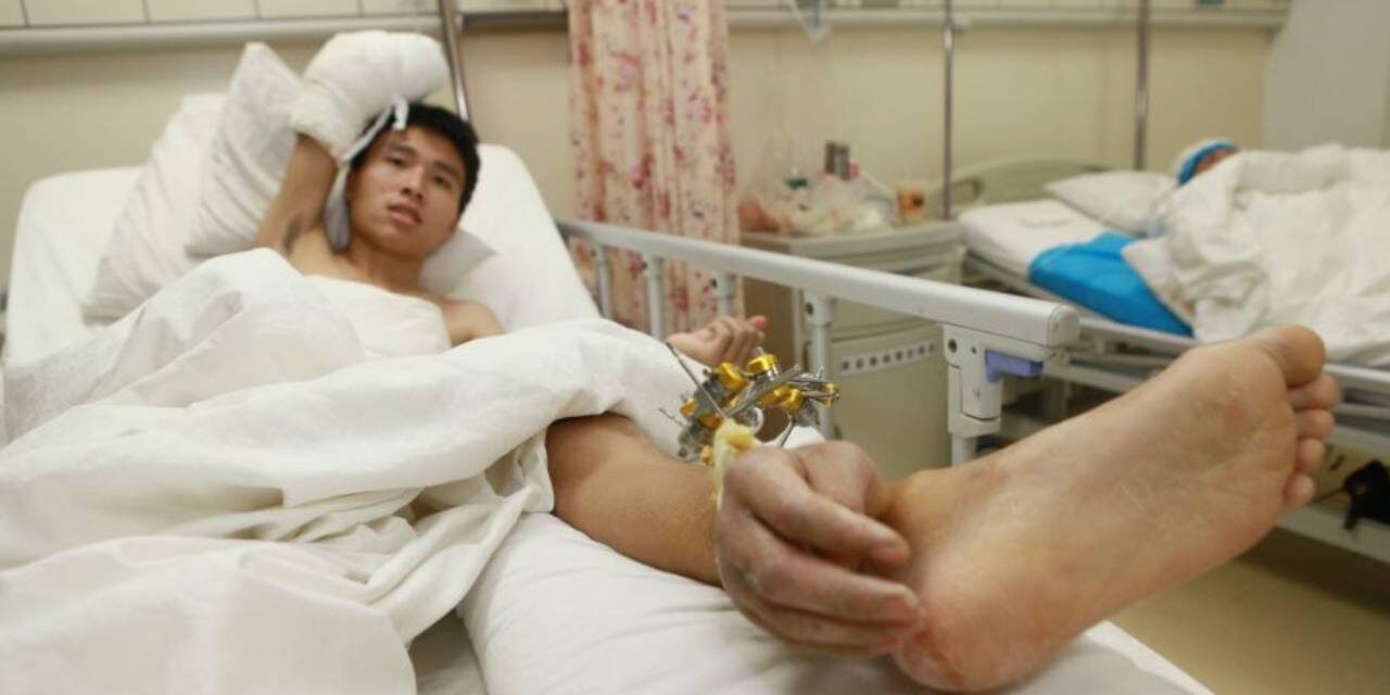 Doctors Save Man’s Severed Hand by Attaching it to His Leg