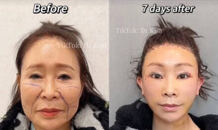 TikTok Plastic Surgeon Goes Viral for Uncanny Before-And-After Videos