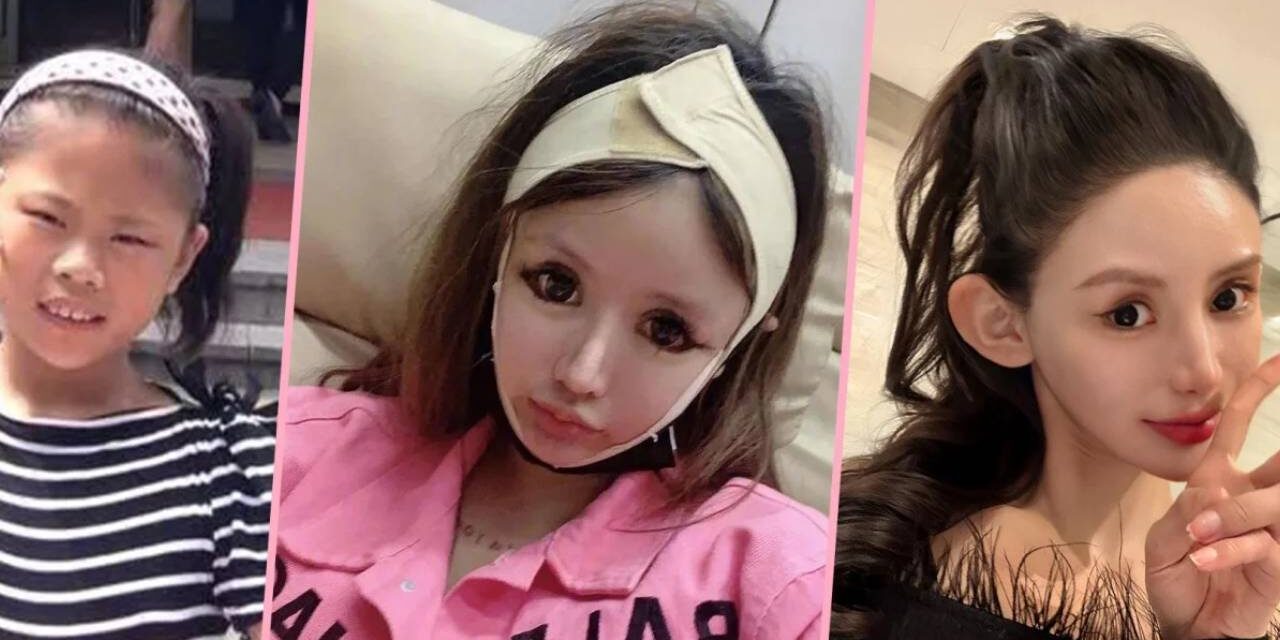 Star-struck China teenage girl splurges US$563,000 of parents’ cash on so much plastic surgery doctors fear one more op could kill her