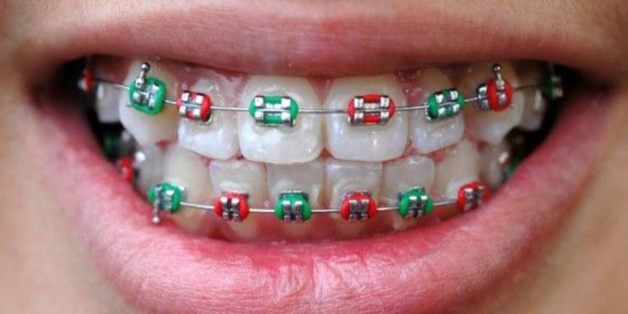 Style Oddities – Fake Braces Worn as Fashion Accessories