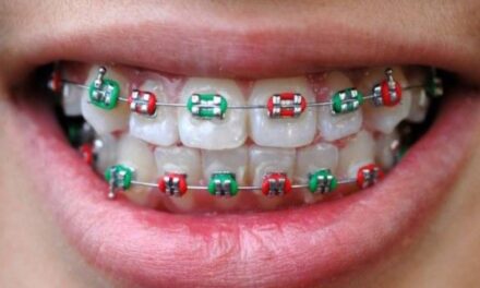 Style Oddities – Fake Braces Worn as Fashion Accessories