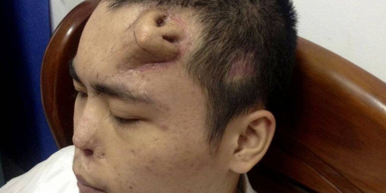 Chinese Car-Accident Victim Has New Nose Grown on His Forehead