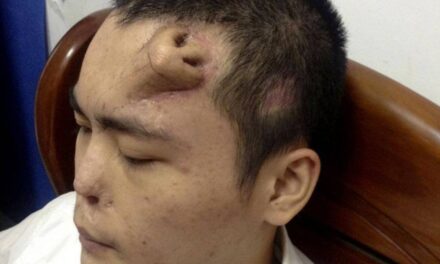 Chinese Car-Accident Victim Has New Nose Grown on His Forehead