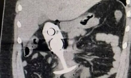 Woman’s three horrifying symptoms after sex toy ‘dragged through body’ in MRI scan