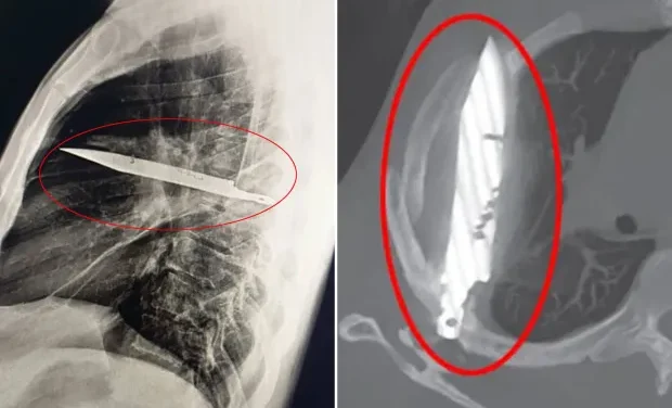 Man with Sore Nipple Shocked to Learn He Had Knife Blade in His Chest for 8 Years