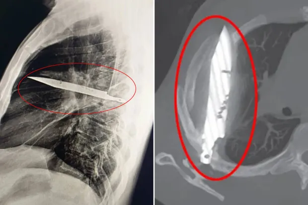 Man with Sore Nipple Shocked to Learn He Had Knife Blade in His Chest for 8 Years