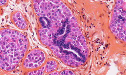 Breast Cancer Often Returns – But We May Have a New Way to Stop It