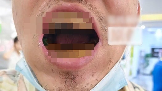 To Save Money, Man Makes His Own Dentures with Materials Bought Online