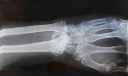 Bone-02, a Bone “Super Glue” That Can Fix Fractures in a Matter of Minutes