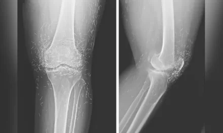Doctors Find Threads of Pure Gold in Woman’s Knees