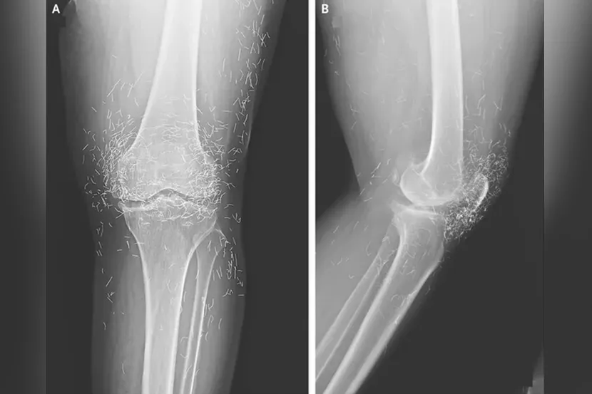 Doctors Find Threads of Pure Gold in Woman’s Knees