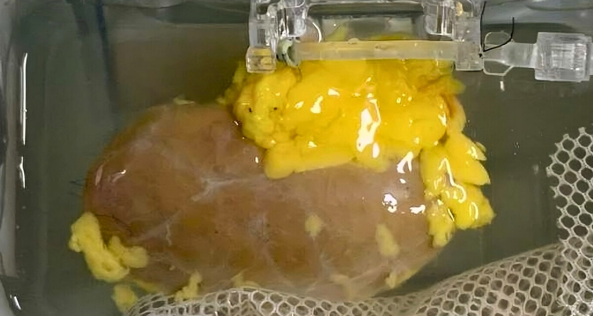 Breakthrough: Scientists Create ‘Universal’ Kidney To Match Any Blood Type