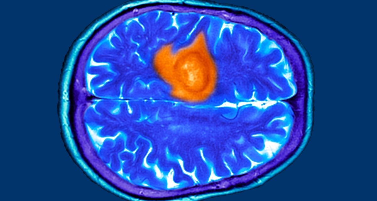 The 7 Warning Signs of Brain Cancer You Might Easily Miss