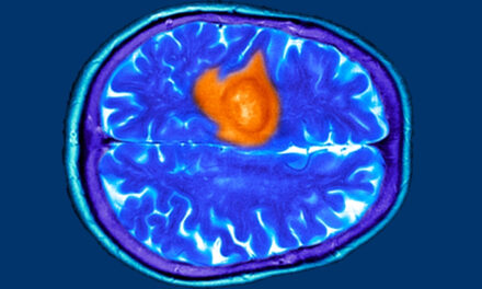 The 7 Warning Signs of Brain Cancer You Might Easily Miss