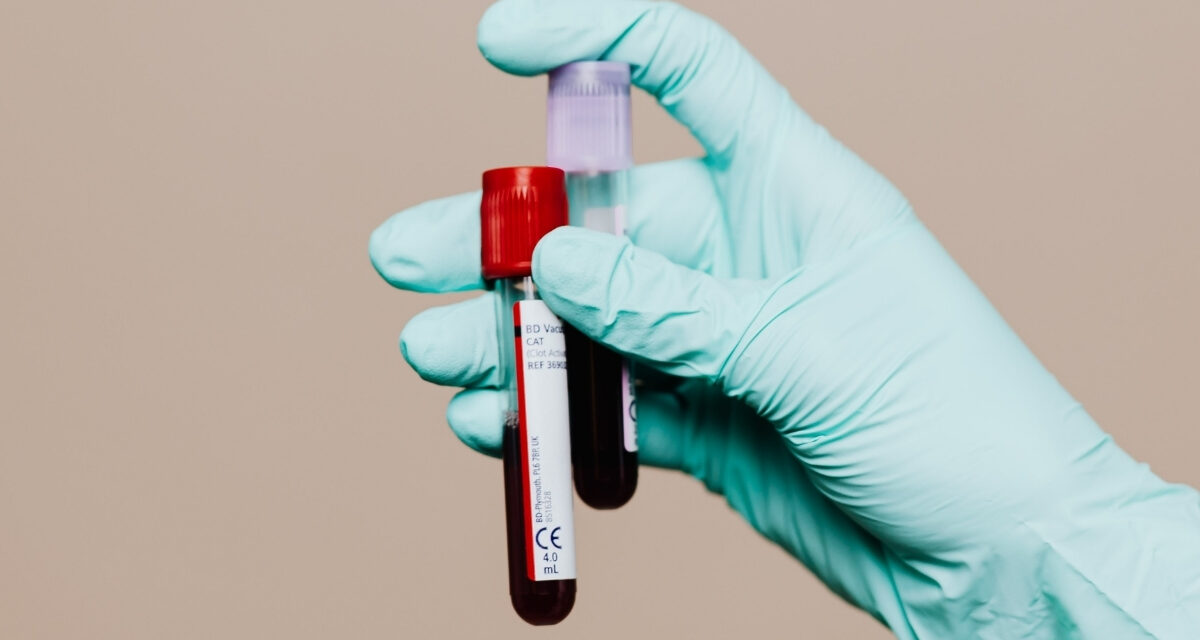 New Chronic Fatigue Syndrome ‘Blood Test’ Raises Hope And Skepticism