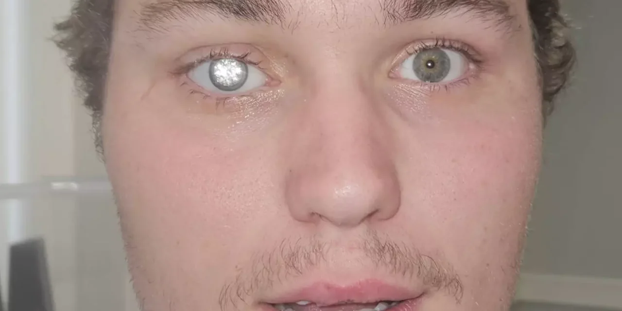Man explains why he got $2million diamond embedded into his eye as shocked people say he looks like ‘Bond villain’