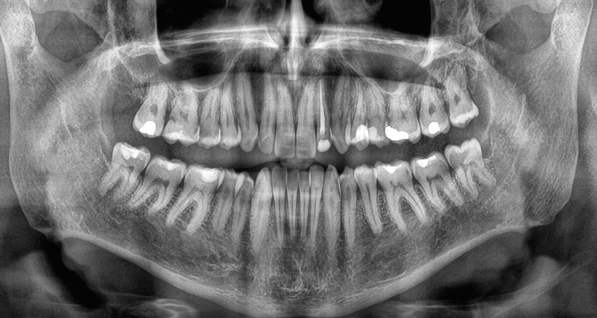 Losing Your Teeth Could Be a Deadly Warning, Study Finds