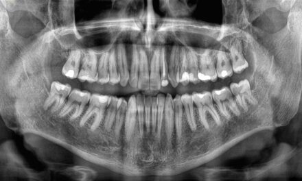 Losing Your Teeth Could Be a Deadly Warning, Study Finds