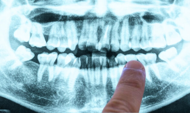 The Cause of Alzheimer’s May Be Coming From Within Your Mouth