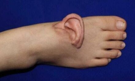 Woman “Wears” Severed Ear on Her Foot for Five Months Before Reattachment