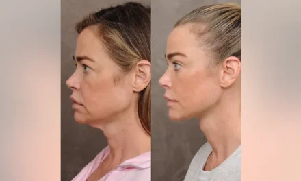 Denise Richards debuts ‘shocking’ facelift transformation in before-and-after photos