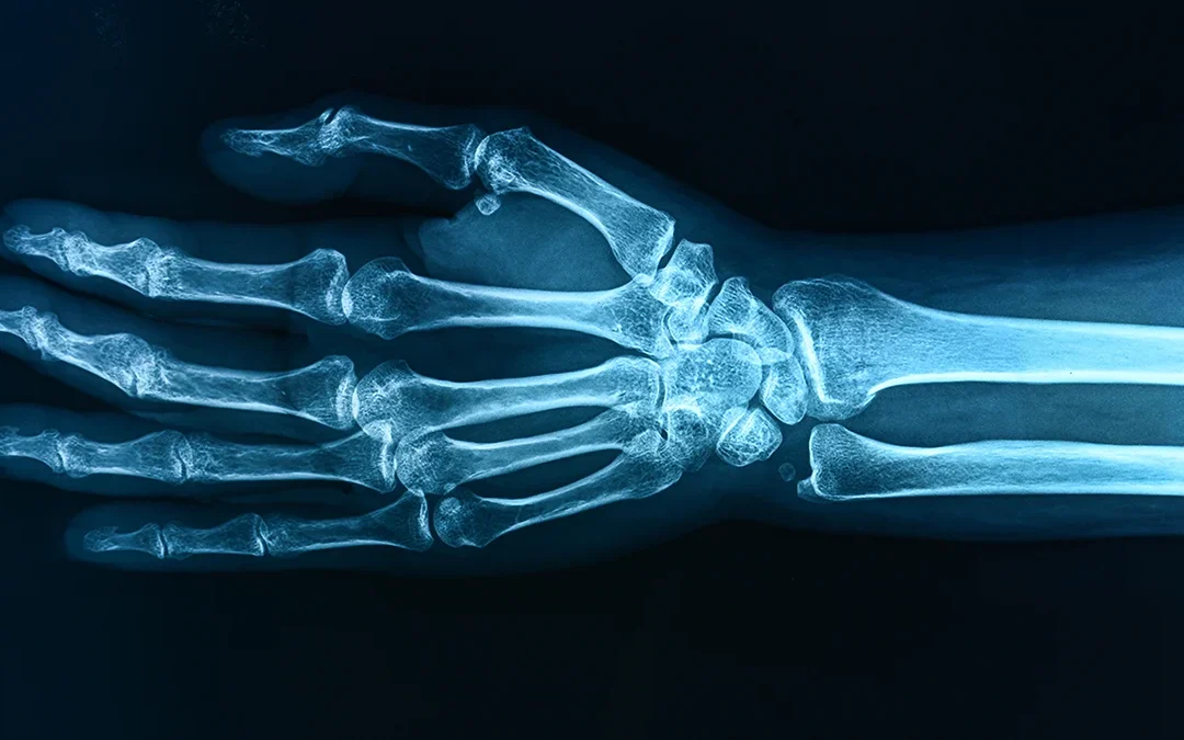 ‘Forever Chemicals’ May Be Weakening The Bones of Children, Study Warns