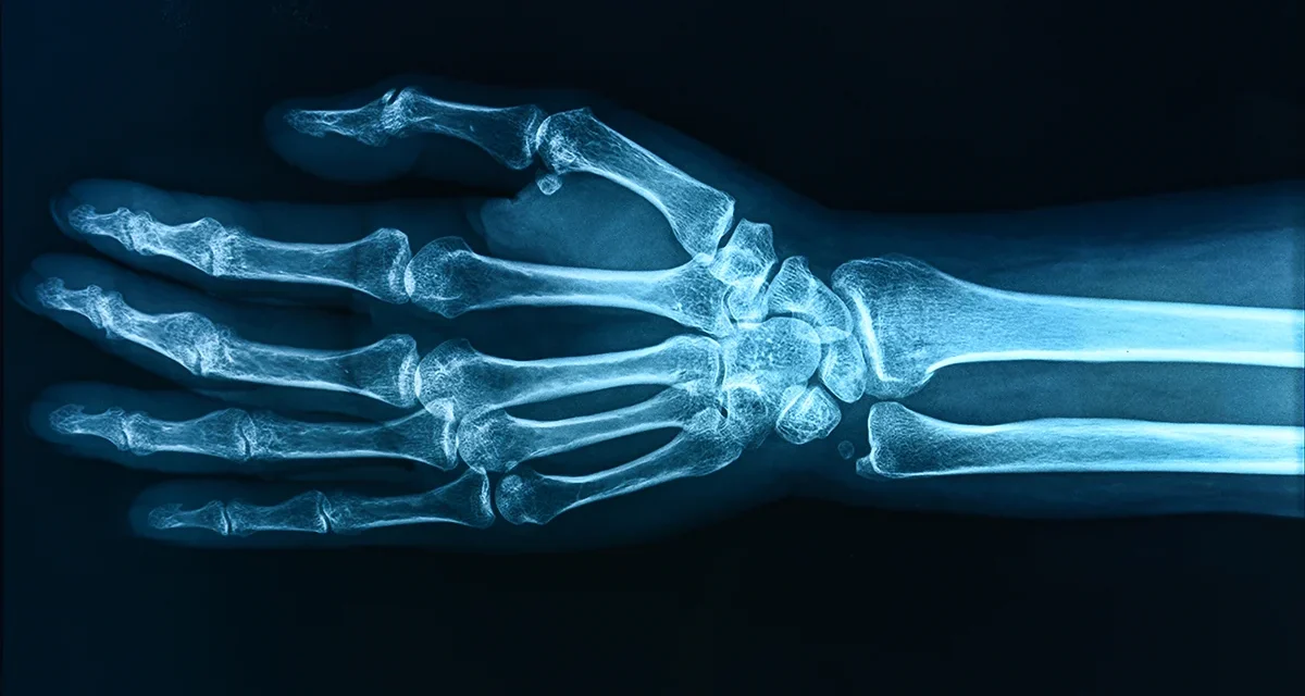 ‘Forever Chemicals’ May Be Weakening The Bones of Children, Study Warns