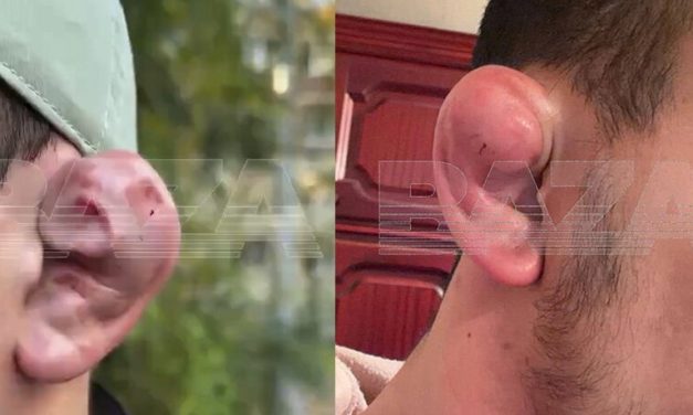 Russian Men Are Allegedly Getting ‘Cauliflower Ear’ Procedures to Look Like MMA Fighters