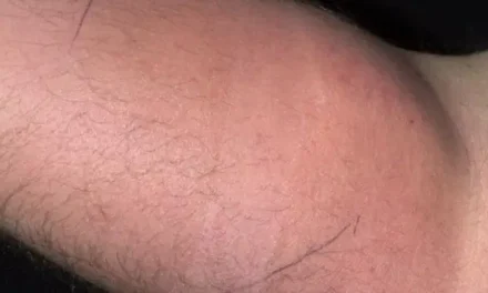 Man turns up at hospital after injecting semen into his arm for 18 months to relieve pain