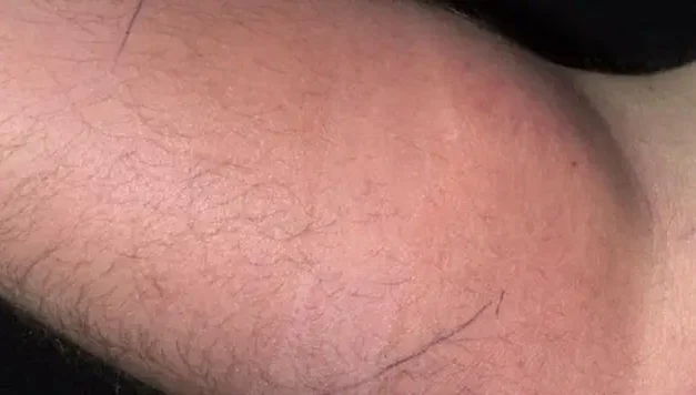 Man turns up at hospital after injecting semen into his arm for 18 months to relieve pain