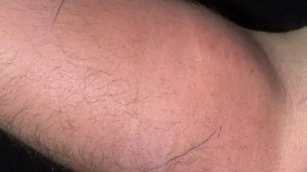 Man turns up at hospital after injecting semen into his arm for 18 months to relieve pain